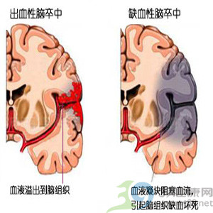 脑出血的八大先兆表现