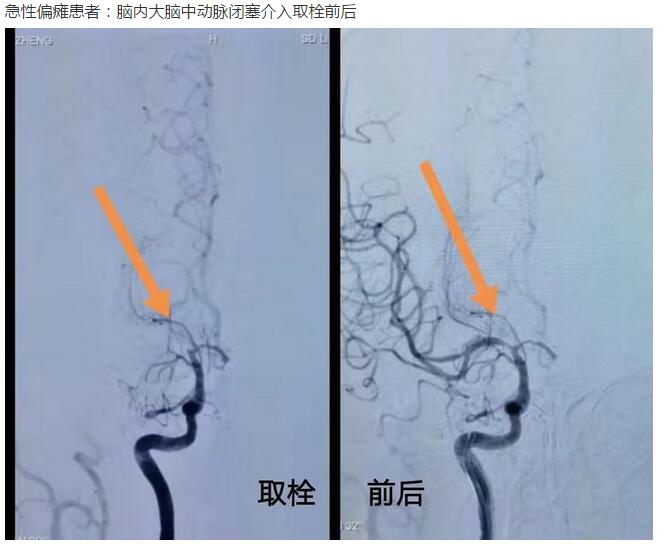 急性偏瘫怎么办?聊城三院帮您看!