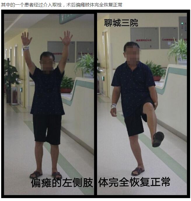 急性偏瘫怎么办?聊城三院帮您看!