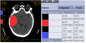 ʯCTGE߶CT