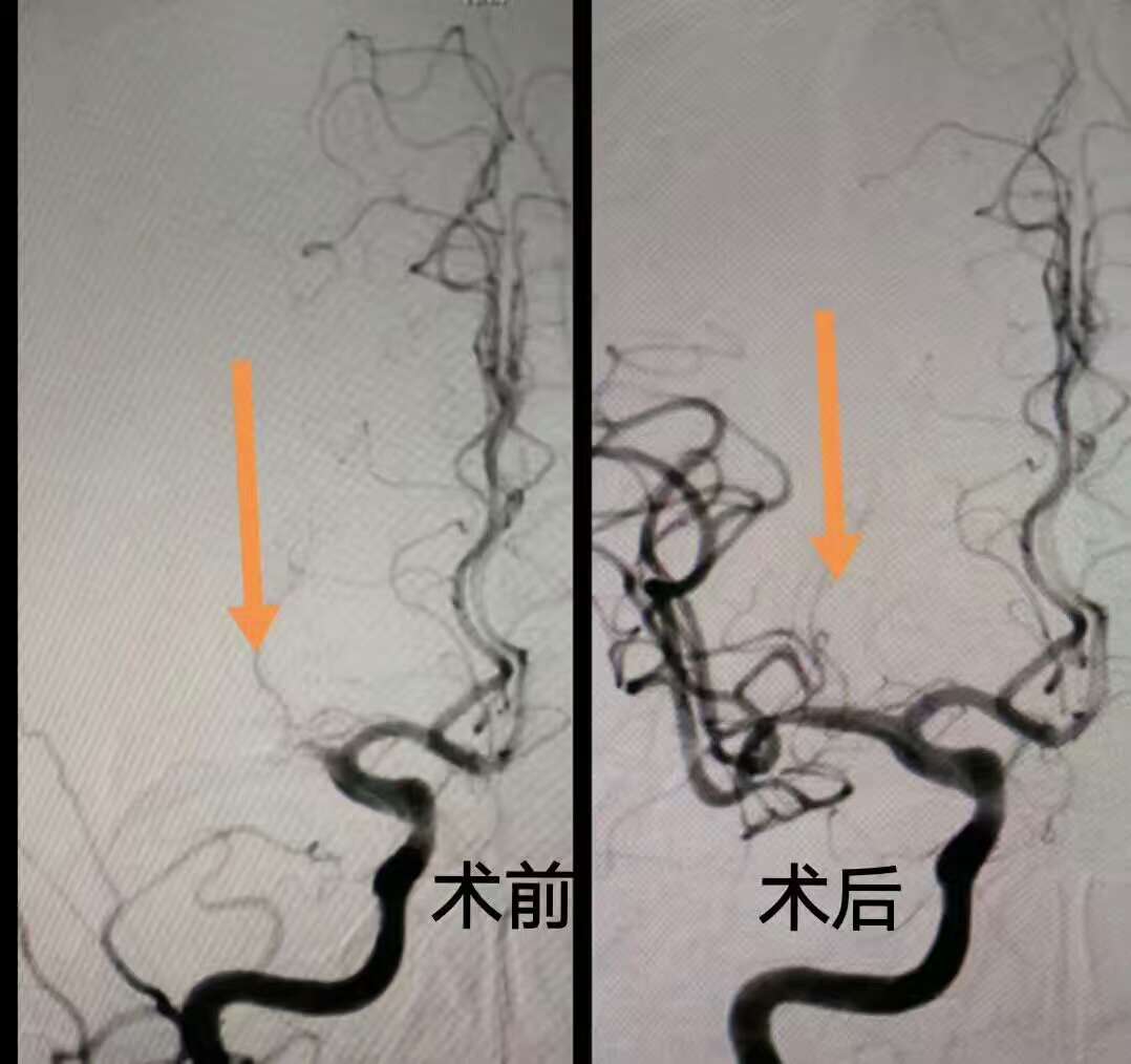 介入取栓：减少残疾，挽救生命！