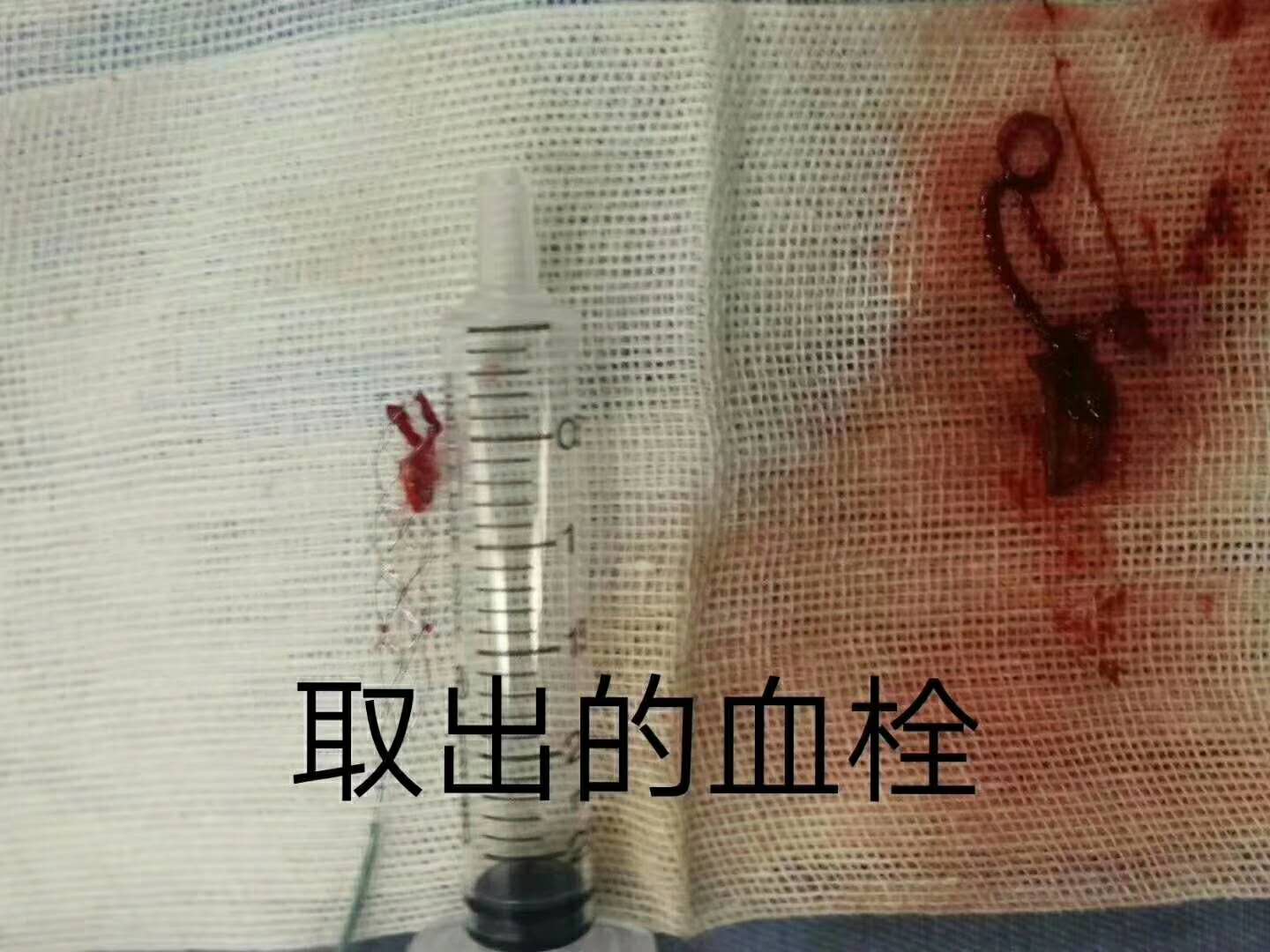 Ժֳɹʵʩ˨ȡ˨Ȳ
