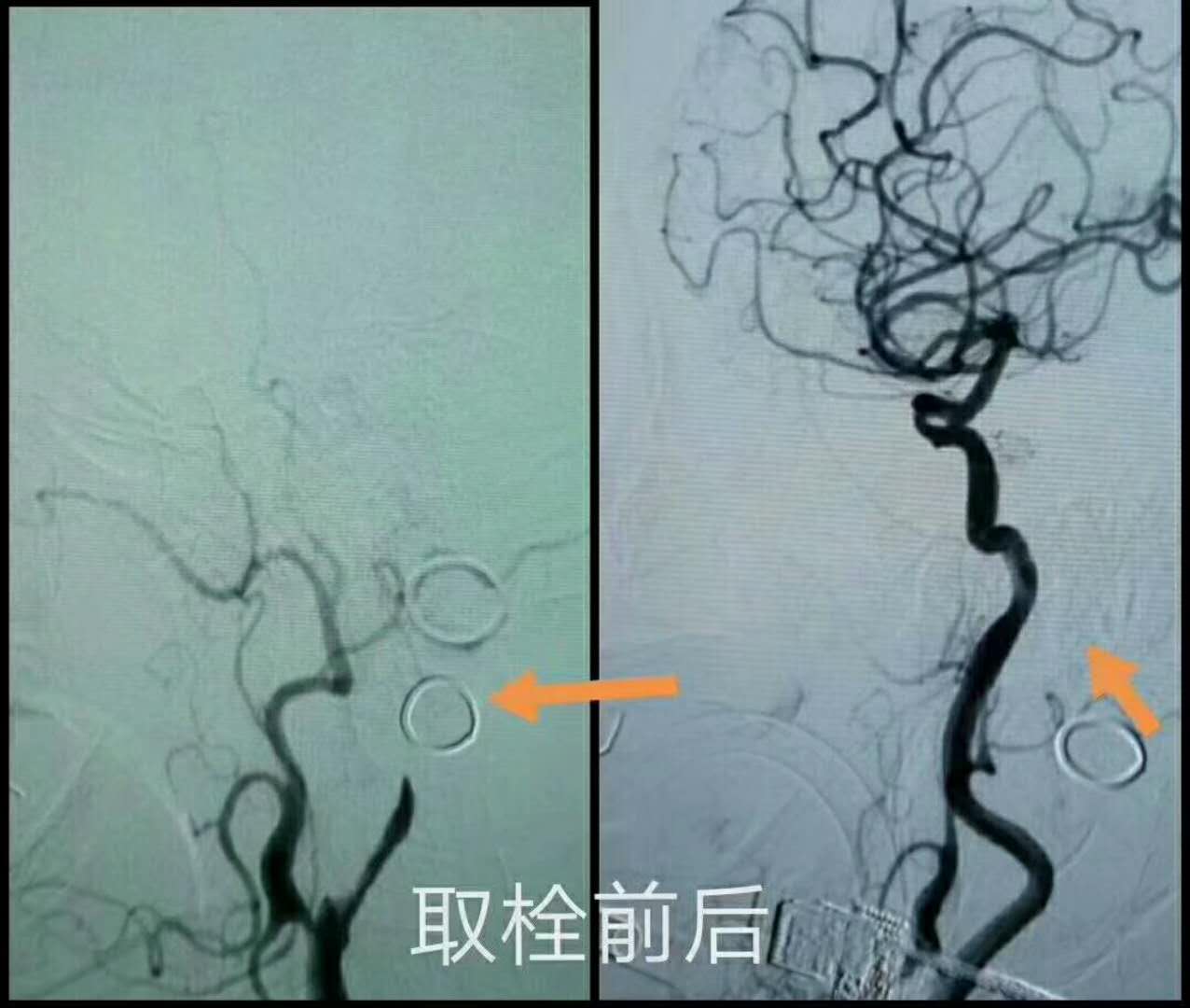 聊城三院今又救治两位急性脑血管病患者