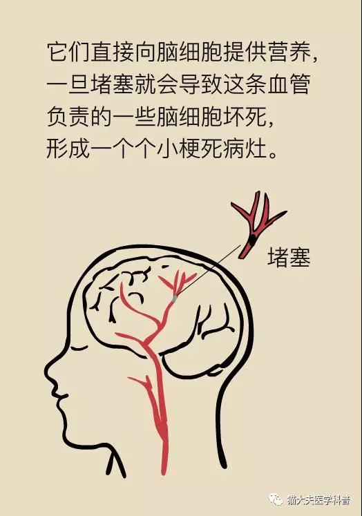 腔梗能自行痊愈么 有腔梗能不能入保险